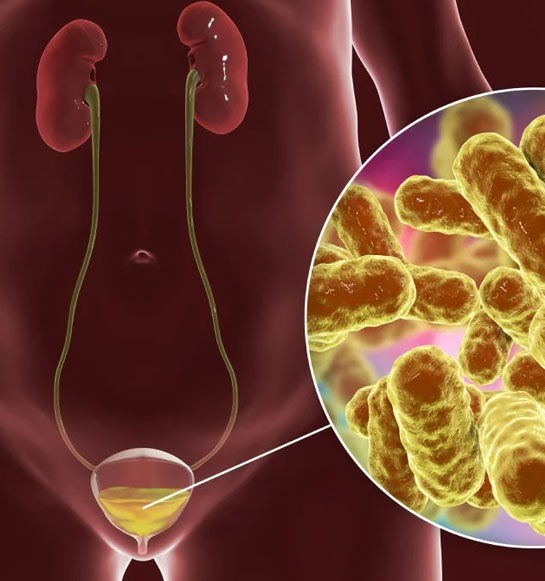 Infecciones Urinarias